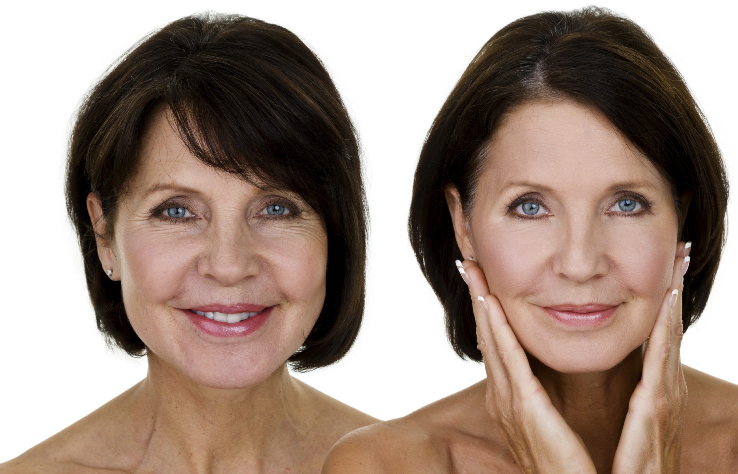4D Fotona Facelift – The Non Invasive Treatment Melbourne Patients Love