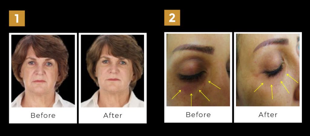 4D facelift 1 1024x450 1