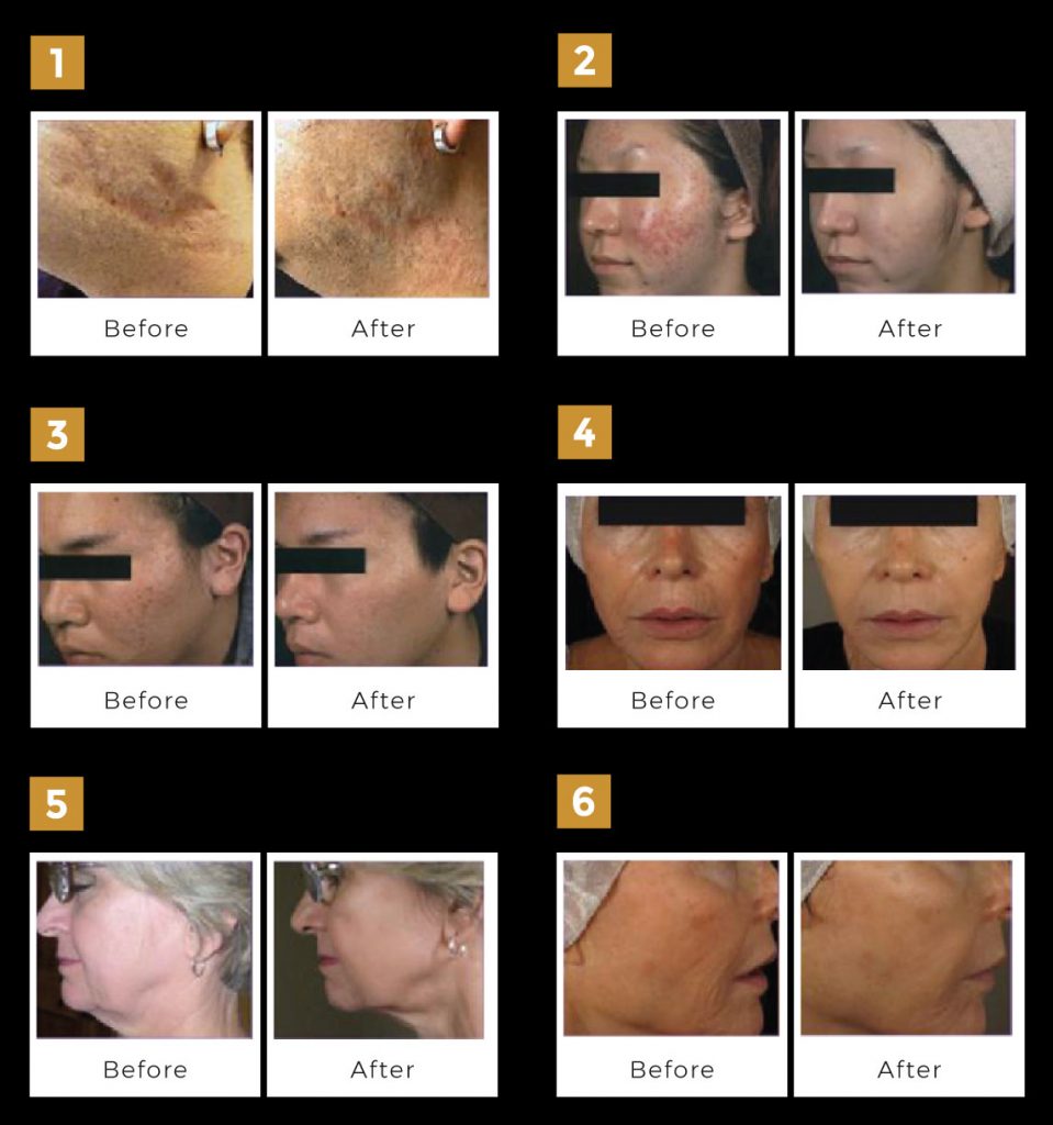 Endymed 3 Deep Fractional Skin Resurfacing Tightening 959x1024 1