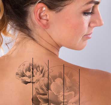 Lasertattooremoval