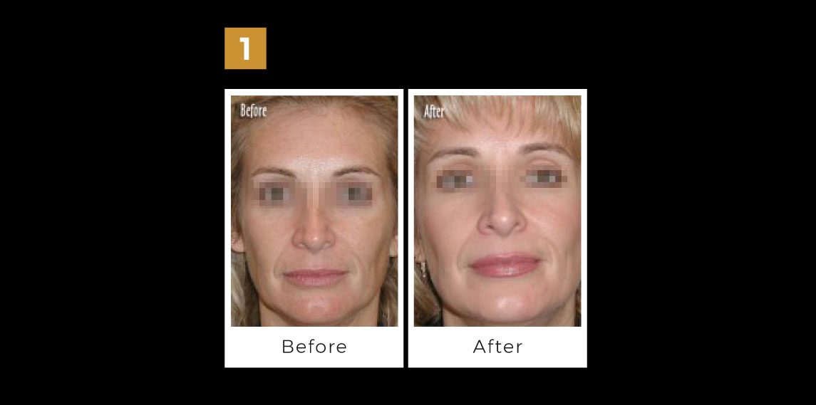 Microdermabrasion Treatments