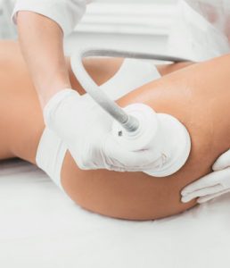 lasercellulite